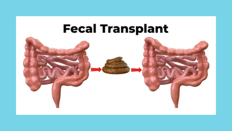 Reviewing Recent Research on Fecal Transplants for Weight Loss